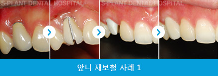 splant-front-teeth-039