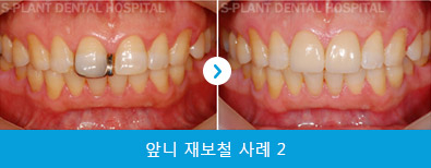 splant-front-teeth-040